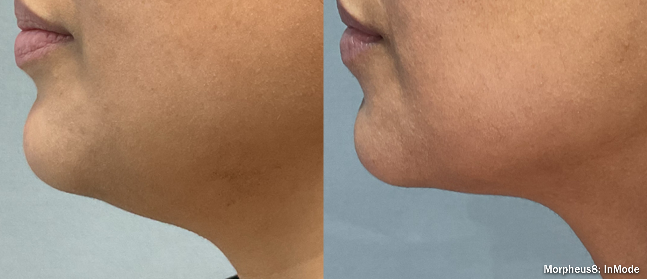Profile view of a woman's chin and neck across a Morpheus8 series, credited to InMode, not a patient of this practice