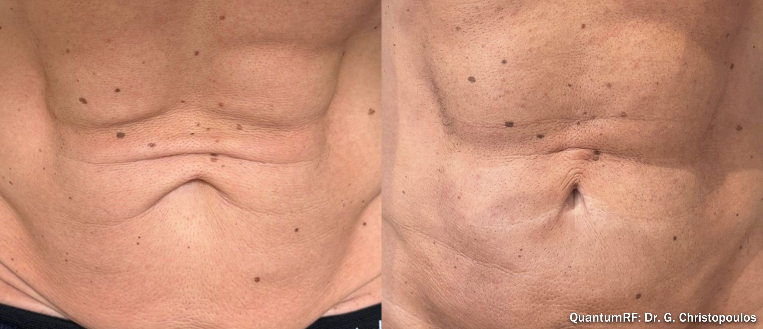 Side by side frames of a man's abdomen across a QuantumRF course, credited to Dr. G. Christopoulos, not a patient of this practice.
