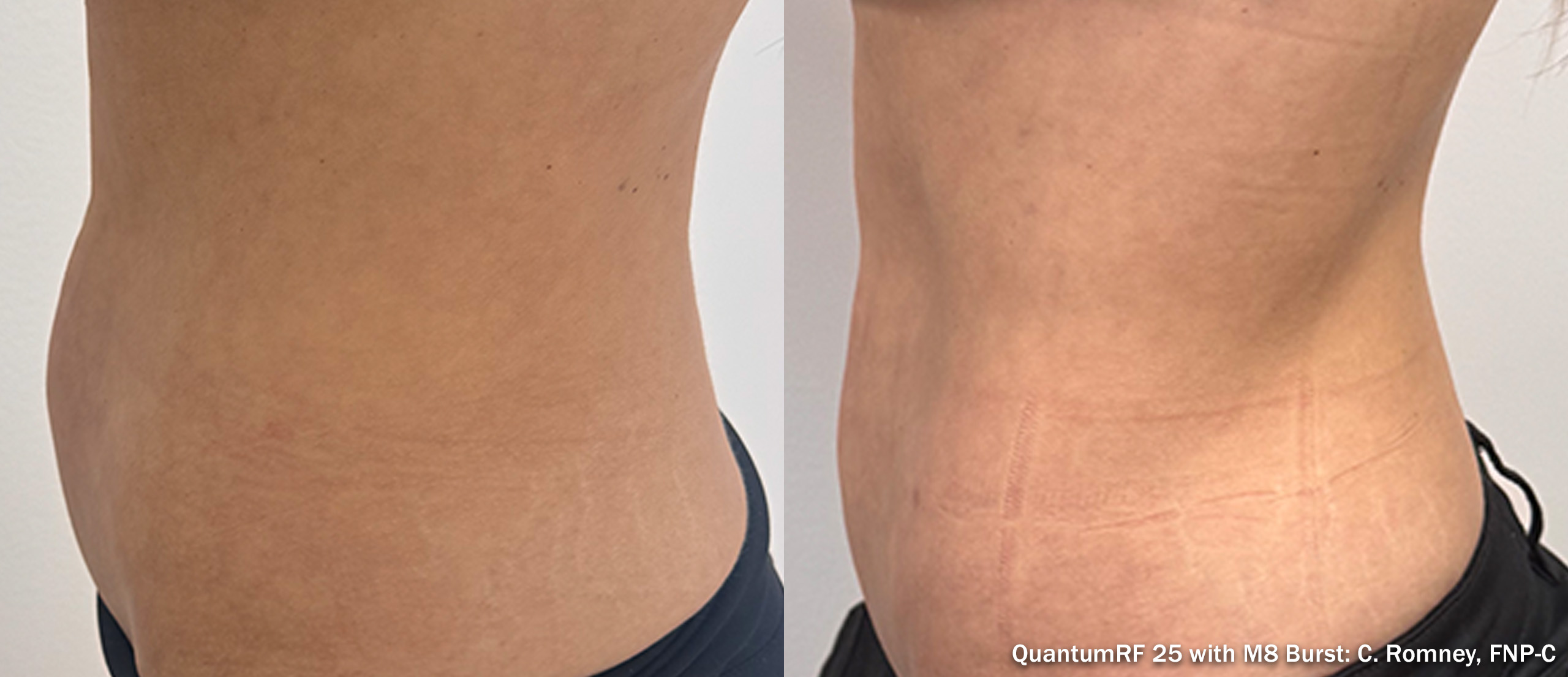 Side by side frames of an abdomen in side view across a QuantumRF 25 with M8 Burst course, credited to C. Romney, FNP-C, not a patient of this practice.