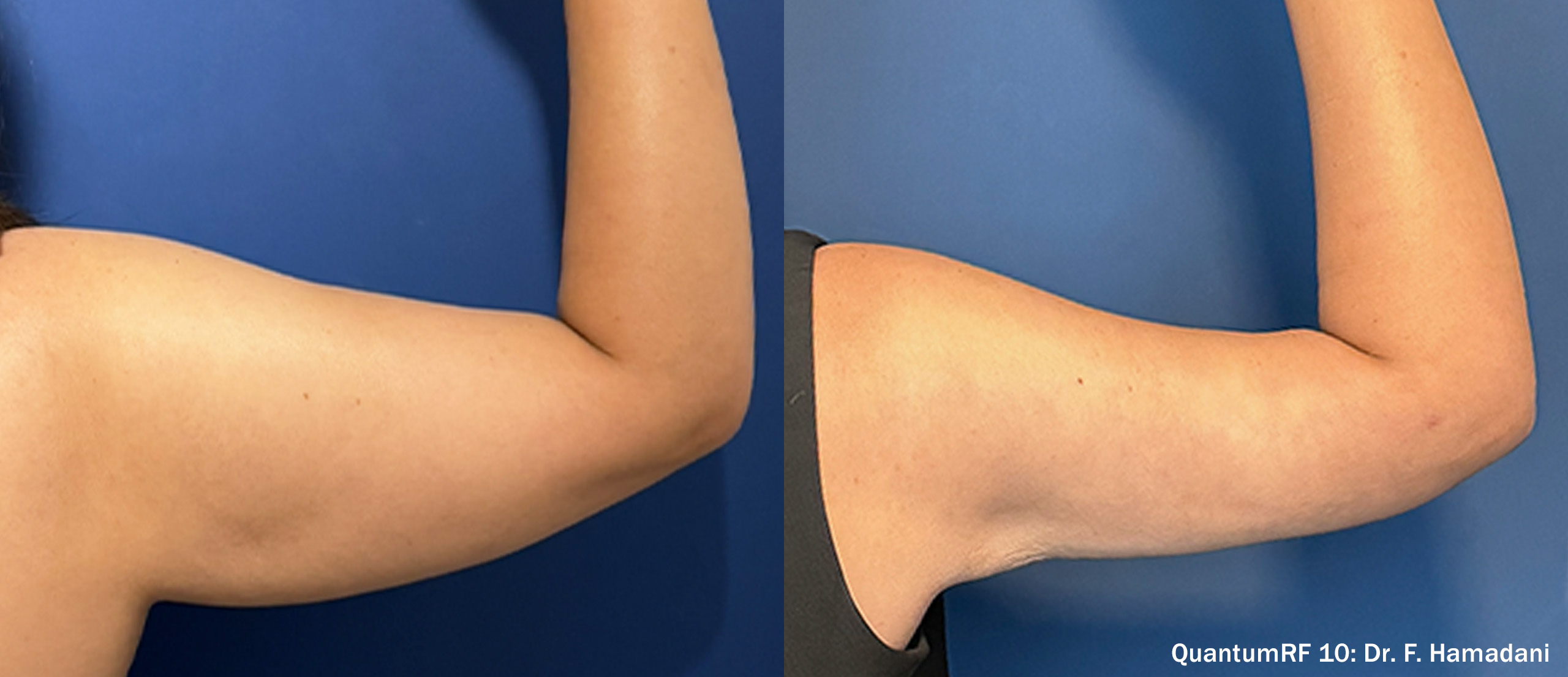 Side by side frames of an upper arm from behind across a QuantumRF 10 course, credited to Dr. F. Hamadani, not a patient of this practice.