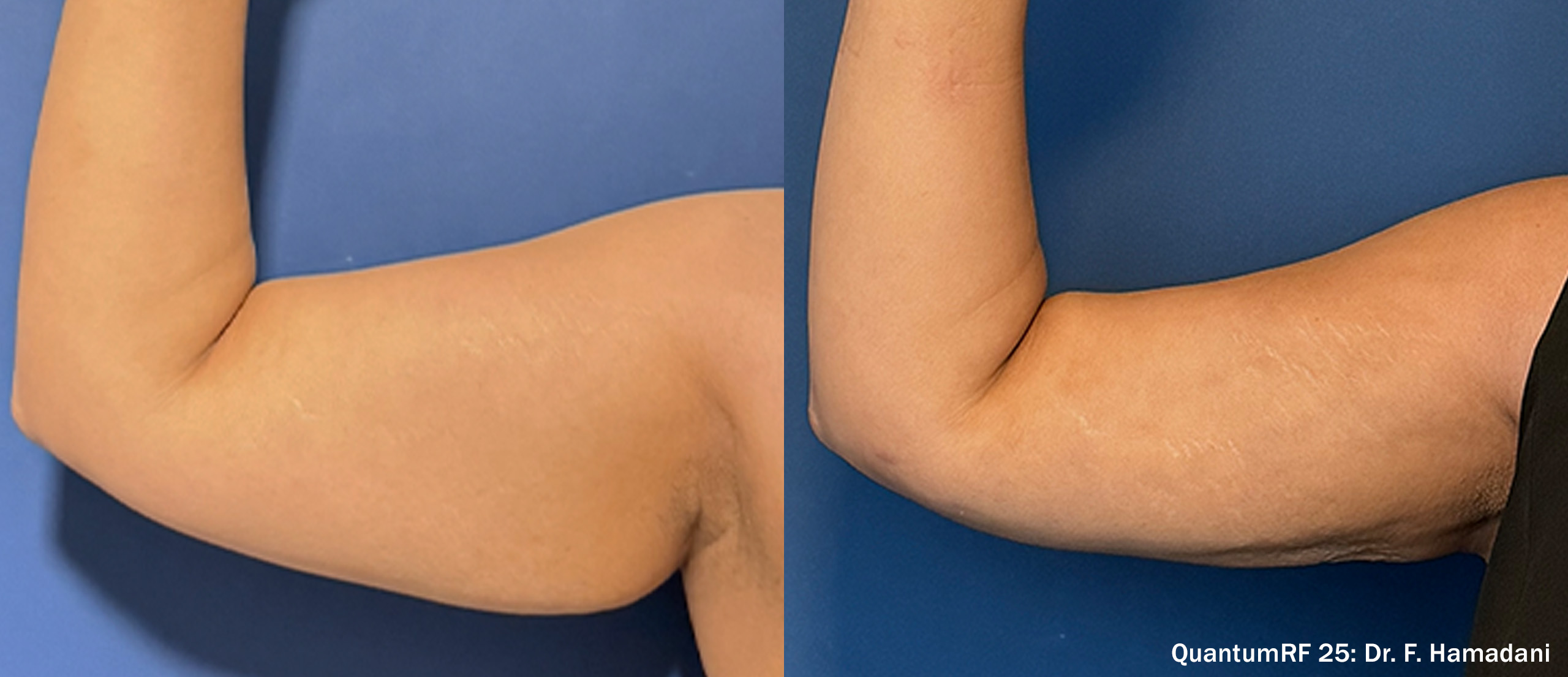 Side by side frames of an upper arm from the front across a QuantumRF 25 course, credited to Dr. F. Hamadani, not a patient of this practice.