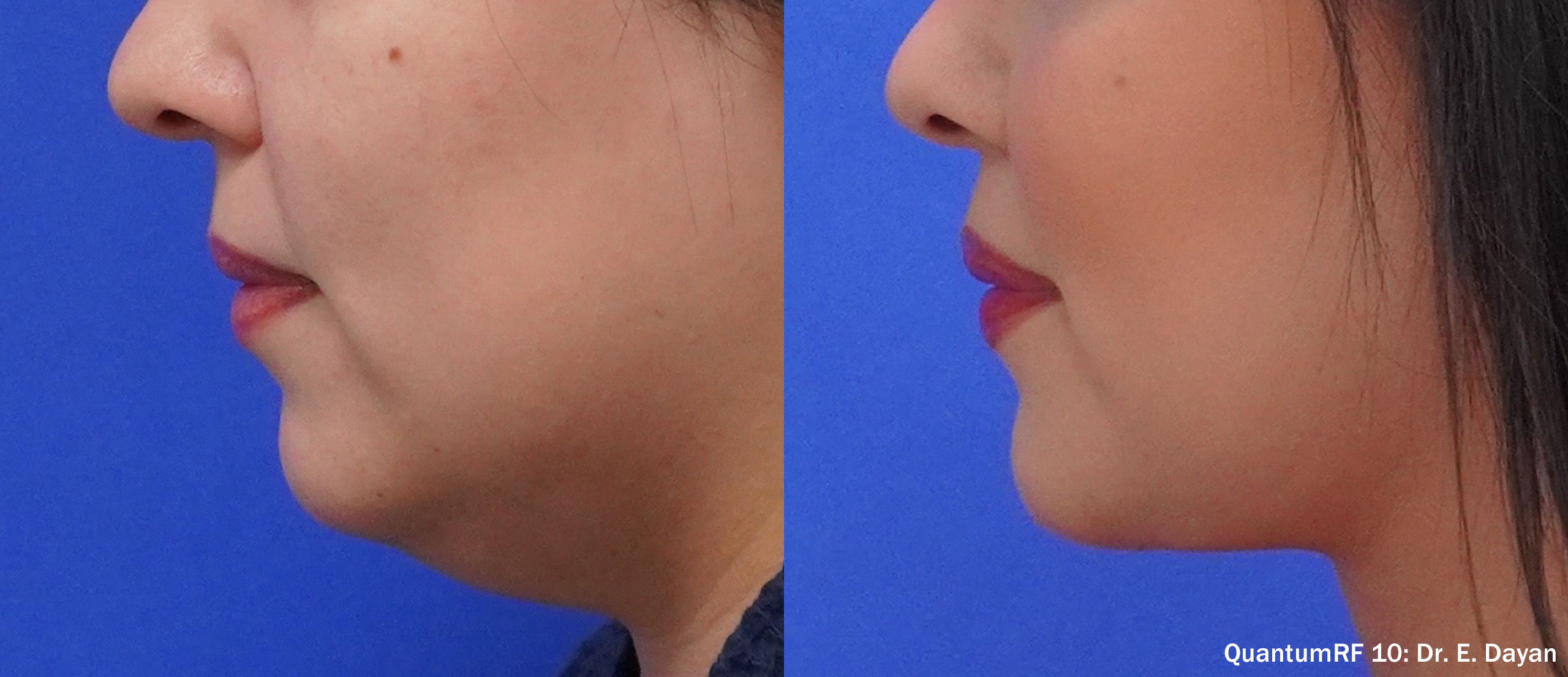 Side by side frames of a jawline and chin across a QuantumRF 10 course, credited to Dr. E. Dayan, not a patient of this practice