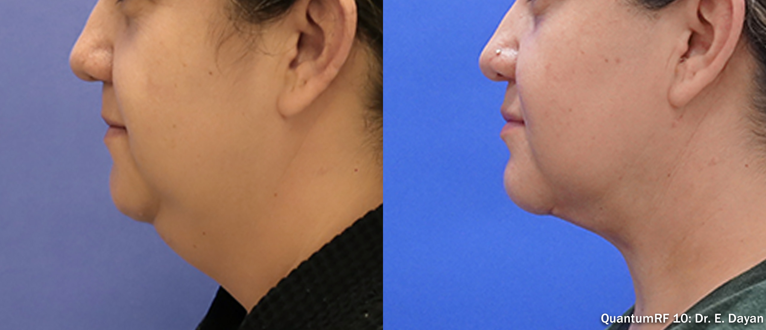 Side by side frames of a chin and jaw in profile across a QuantumRF 10 course, credited to Dr. E. Dayan, not a patient of this practice.