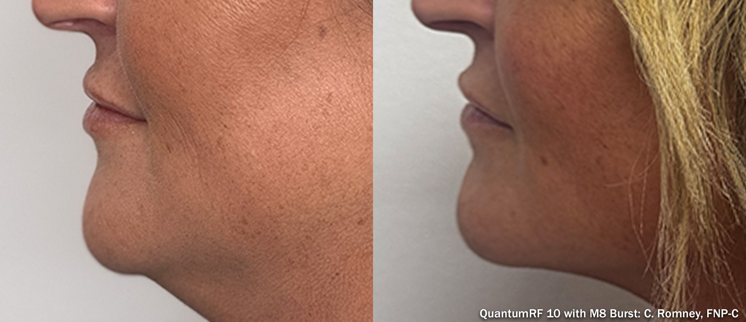 Side by side frames of a lower face and jawline across a QuantumRF 10 with M8 Burst course, credited to C. Romney, FNP-C, not a patient of this practice.