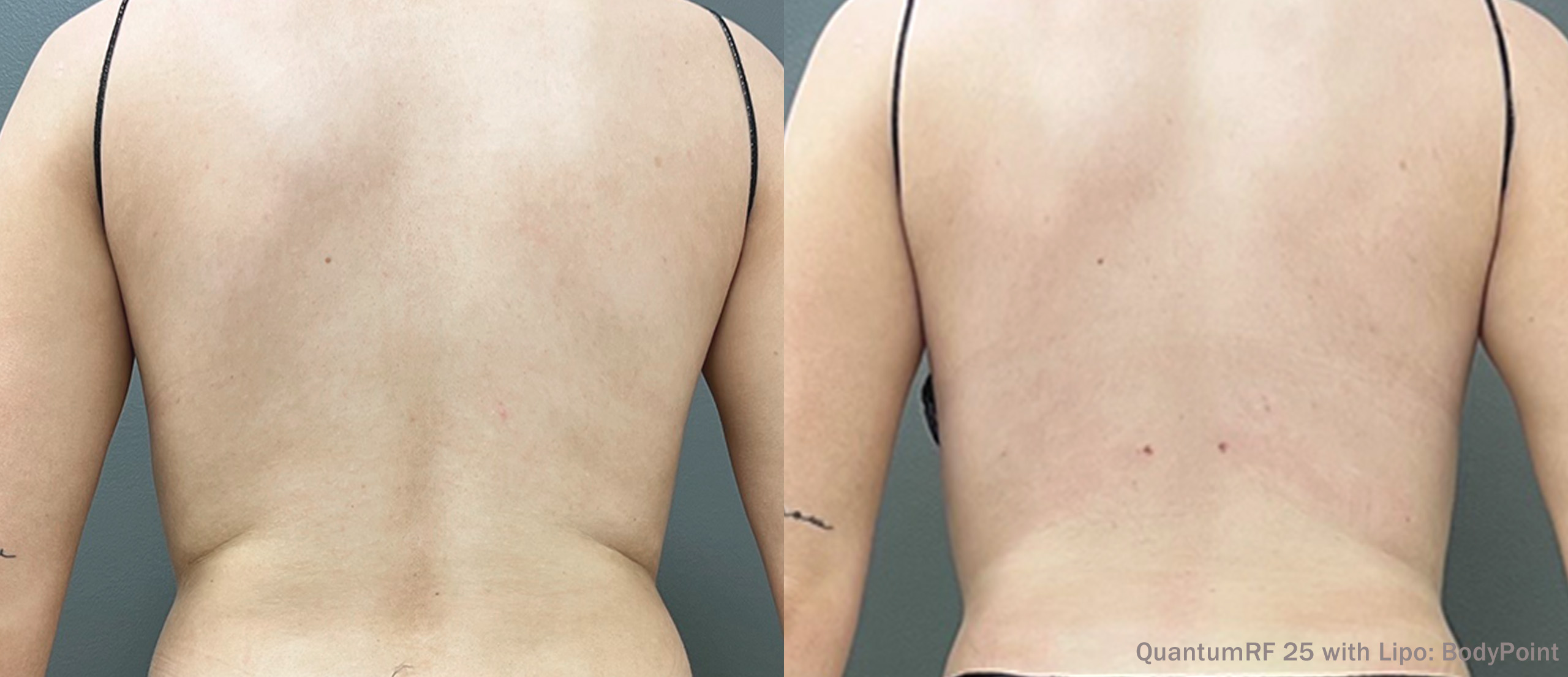 Side by side frames of flanks from behind across a QuantumRF 25 with Lipo course, credited to BodyPoint, not a patient of this practice.
