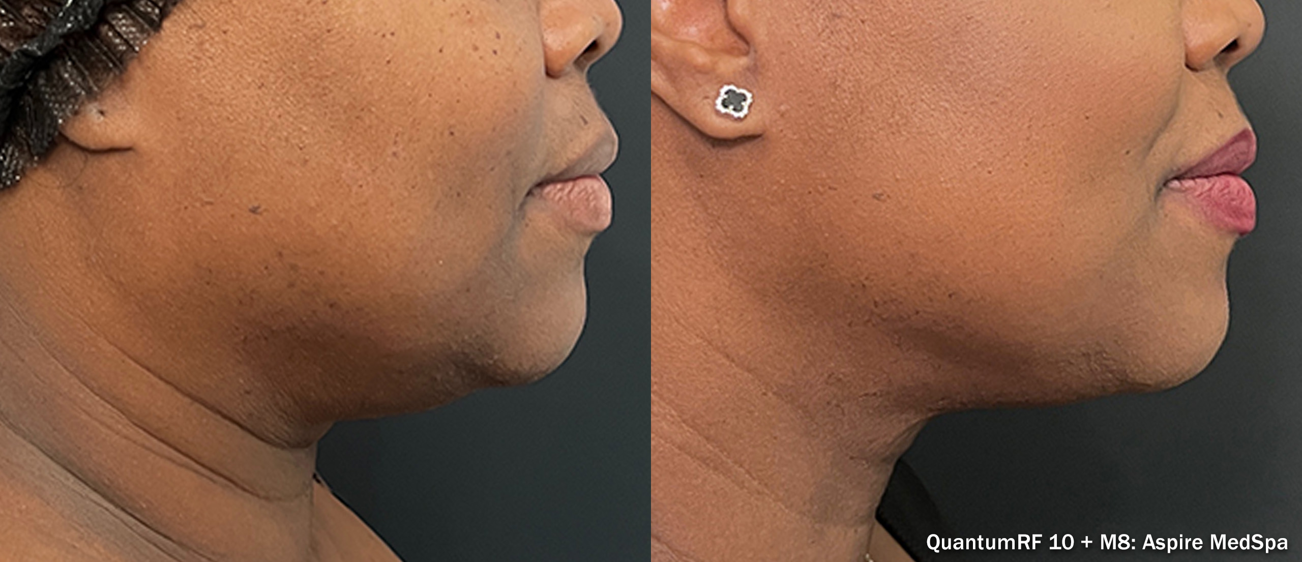 Side by side frames of a jawline and chin across a QuantumRF 10 and M8 course, credited to Aspire MedSpa, not a patient of this practice