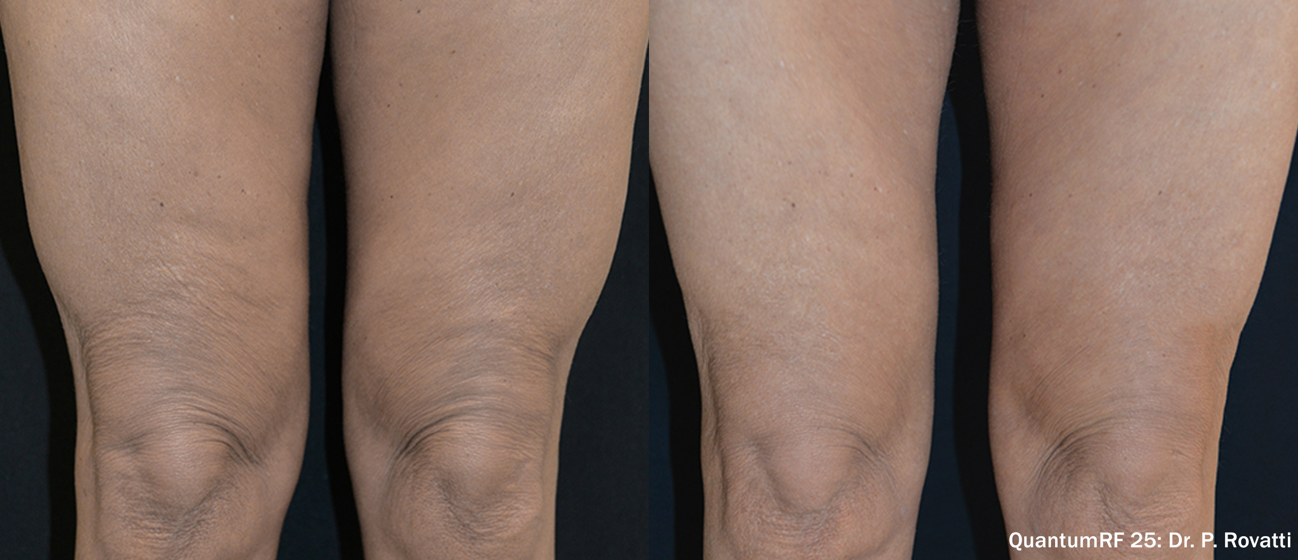 Side by side frames of thighs from the front across a QuantumRF 25 course, credited to Dr. P. Rovatti, not a patient of this practice.